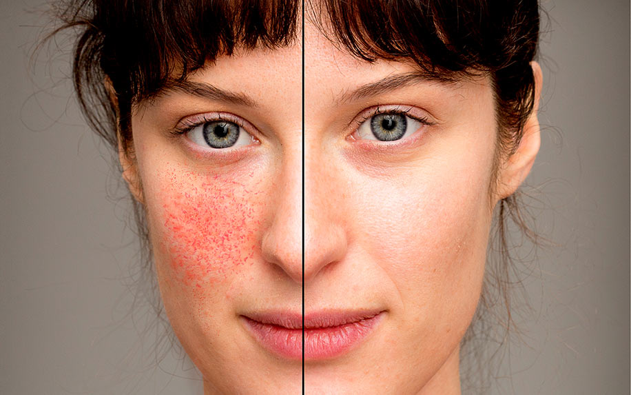 Here’s How CBD Cream May Help With Rosacea